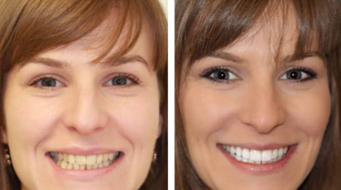 Що криворіжцям необхідно знати про встановлення вінірів вініри